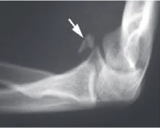 Figure 9  Fracture de l’apophyse coronoïde de type I après réduction d’une luxation du coude Chartier (25) 