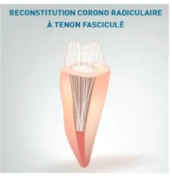 Figure 1 : Restauration corono-radiculaire avec micro-tenons  fasciculés (tenons Biolight Plus) 