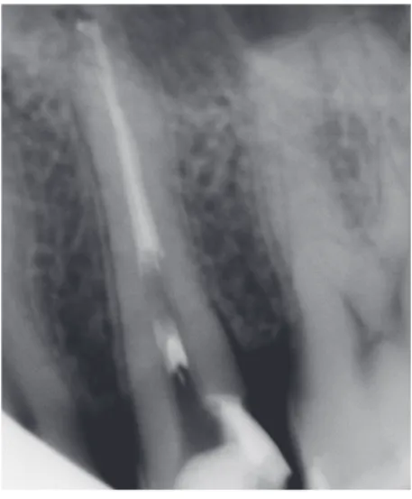 Figure 9 : Dent n°25 présentant un délabrement  important 