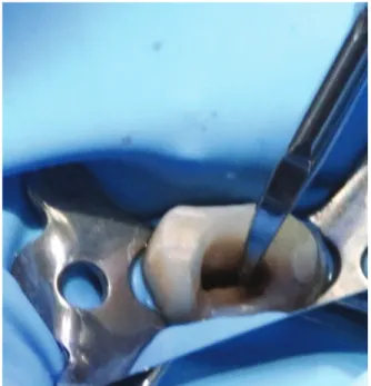 Figure 12 : Nettoyage intra-canalaire avec un insert ultrasonique diamanté 