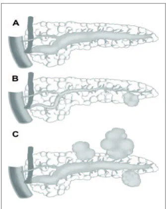 Figure 1 - Trois types morphologiques de TIPMP 