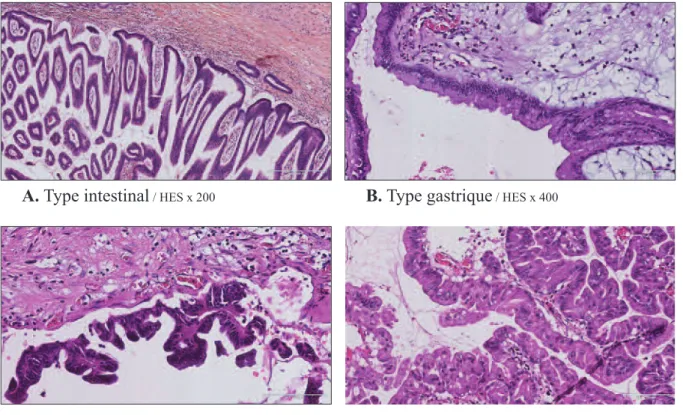 Figure 2 - Quatre types histologiques :