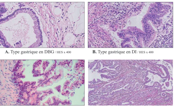 Figure 4 - Aspects microscopiques des différents degrés de dégénérescence