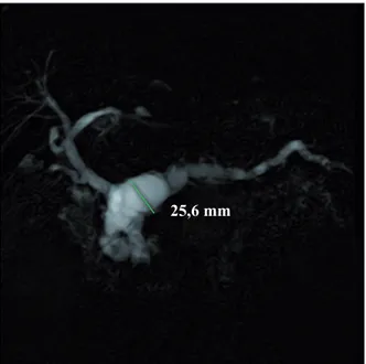 Figure 5 - Aspect de TIPMP du canal principal avec dilatation diffuse du canal principal