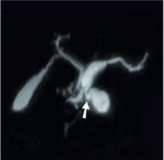 Figure 8 - Aspect de TIPMP mixte (CP-IRM avec reconstruction 3D)