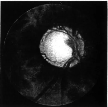 Figure 21: Atrophie optique glaucomateuse avec excavation évidente (83). 