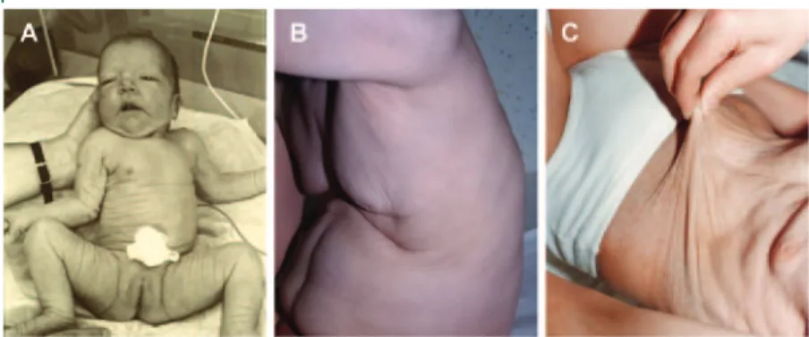 Figure 2 In Debre ´ type autosomal recessive congenital cutis laxa, the wrinkles or skin folds are narrow and shallow, especially in comparison to the skin folds in the pulmonary emphysema type