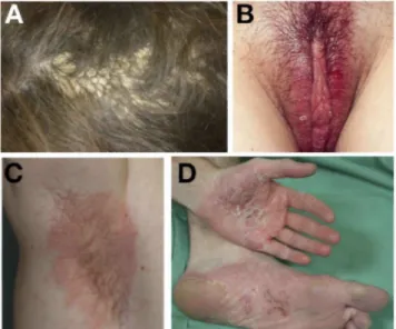 Figure 1. (A) Psoriasiform lesions of the scalp (tinea amiantacea form) induced by infliximab