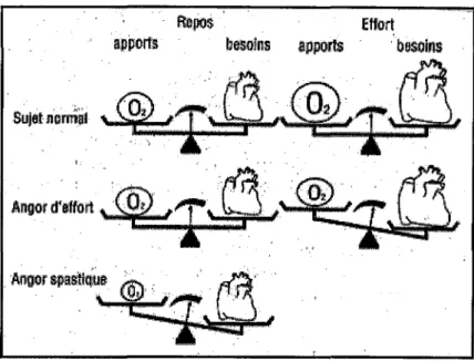 Fig. 25: Cause d'une ischémie myocardique. 