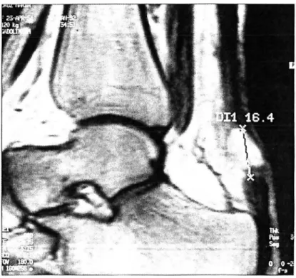 Figure 4. IRM : Rupture du tendon d'Achille 