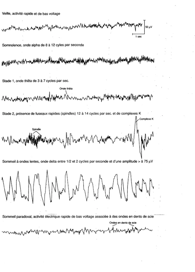 Figure  l  : Exemples  de  tracés électroencéphalographiques associés  avec  les  stades  l  à  4  du  sommeil lent et l'état du sommeil paradoxal selon BlLLIARD M