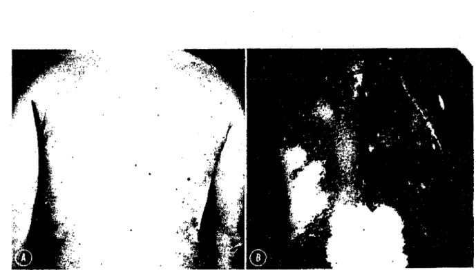 Figure 16: Photos de patients en lumière visible (a)  et  sous lampe de Wood (b) 