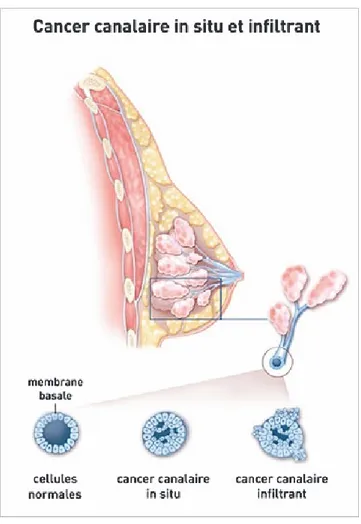 Figure 5. Représentation du cancer du sein canalaire In situ et Infiltrant (d’après INCa, 2016).  