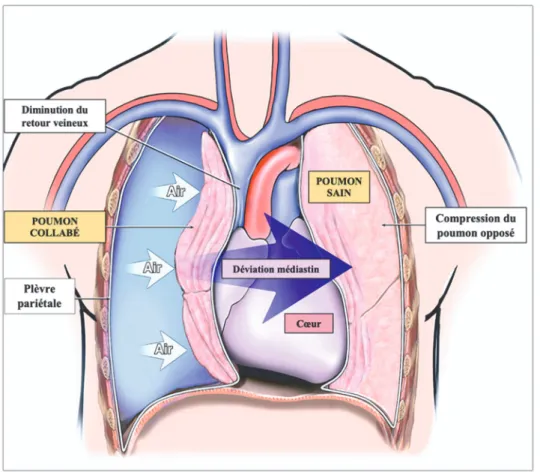 Figure 1 : Physiopathologie du pneumothorax compressif. 