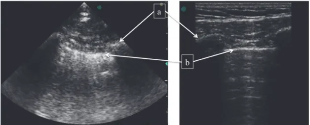 Figure 3 : EPP physiologique en mode TM. 