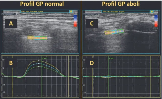 Figure 10 : Profils type du GP normal et du GP aboli en analyse par speckle-tracking.  