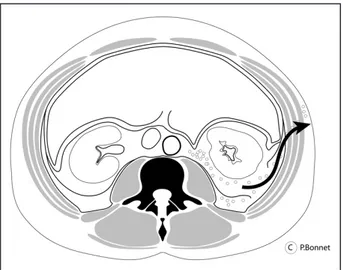 Figure 4. Signe de Grey-Turner. Coupe transversale du tronc au niveau lom- lom-baire La flèche indique la progression de la suffusion rétropéritonéale dirigée  vers la paroi latérale et extériorisée au niveau du flanc.