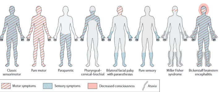 Figure 3. Variants cliniques de syndrome de Guillain-Barré  Source : Leonhard, 2019 (13) 