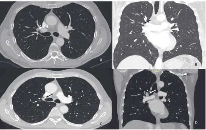 Figure 4: Scanners sans injection de produit de contraste en fenêtre médiastinale montrant sur la rangée supérieure  un hamartome comme un nodule périphérique solide (flèches) en coupe axiale (A) et dans la rangée inférieure une  tumeur carcinoïde en coupe