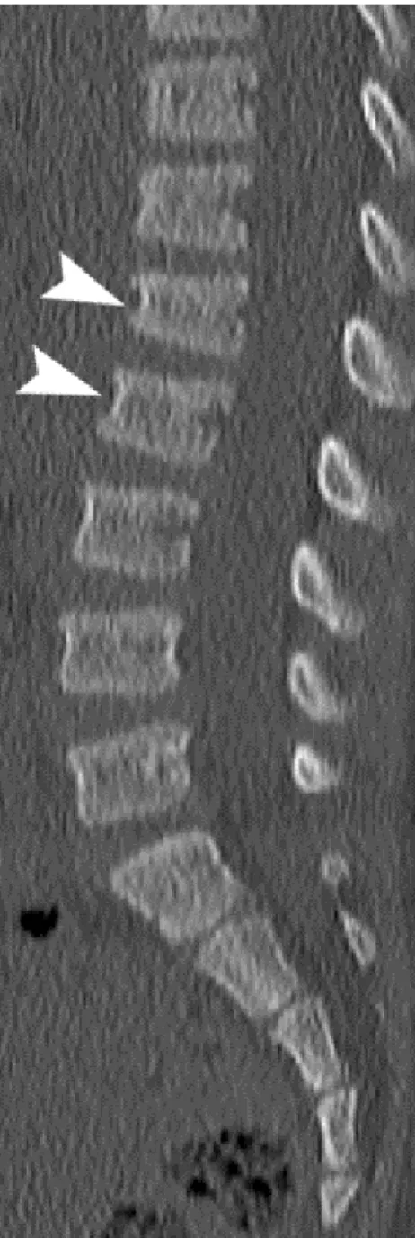 Figure 4. Exemple : garçon de 3 ans écrasé sur le dos par un portail de 125 kg. 