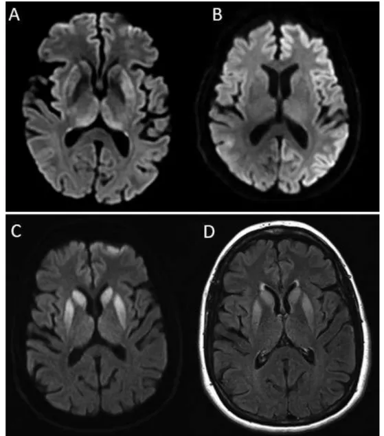 Figure 7 : IRM cérébrale en coupe axiale. A : Séquence diffusion, hypersignaux des noyaux gris centraux  (noyau caudé, putamen, thalamus) ; B : Séquence diffusion, hypersignaux corticaux hémisphériques  gauche ;  C  et  D :  Madame  P