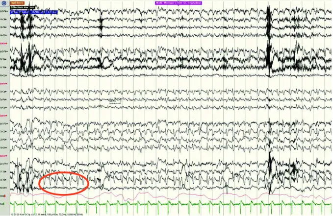 Figure 8 :  Tracé EEG altéré retrouvant des ondes triphasiques diffuses mais à nette prédominance  gauche, périodiques à 1 Hz environ, compatible avec une maladie de Creutzfeld-Jakob