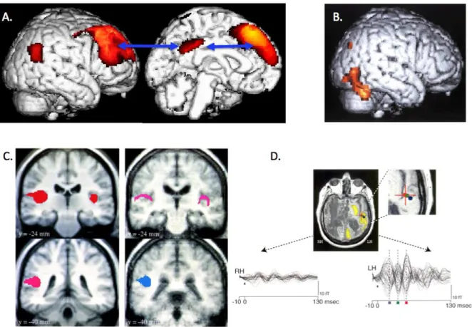 Figure 2. Loss of functional connectivity and modularity in the vegetative state.  