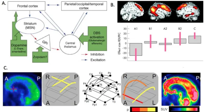 Figure 6. Linking models of spontaneous and induced recovery of consciousness: the  possible interactions of the anterior forebrain mesocircuit and posterior medial  complex