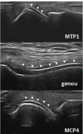 Figure 31 : Aspect échographique du double contour (indiqué par les têtes de flèches) au niveau de plusieurs articulations  (MTP1 = 1 ère  articulation métatarsophalangienne ; MCP4 = 4 ème  articulation métacarpophalangienne)  au cours de la goutte 