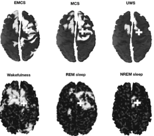 Fig. 3   Effective connectivity assessed by transcranial magnetic stimulation combined with high-density  electroencephalography in a healthy control during wakefulness, rapid eye movement (REM), and non-REM  sleep (NREM), and in patients in emergence from