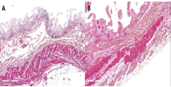 Figure 9 : Aspect histologique de l’ischémie mésentérique aiguë précoce réversible (non nécrosante  (A)) et tardive irréversible (nécrosante (B)) 