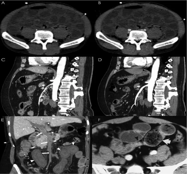 Figure 10 : L’angioscanner abdominal aux temps non injecté, artériel et portal : pierre angulaire du  diagnostic d’ischémie intestinale 
