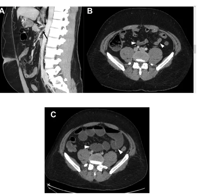 Figure 11 : Evolution scanographique en 48h : des signes directs d’occlusion vasculaire sans signe de  souffrance digestive vers des signes de nécrose intestinale 