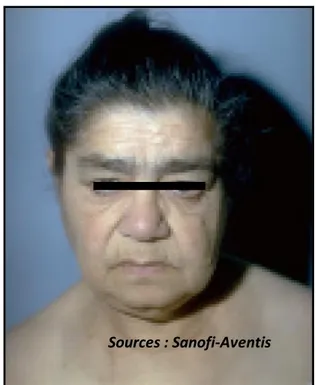 Figure 6 : Anomalies caractéristiques du visage d’un patient 