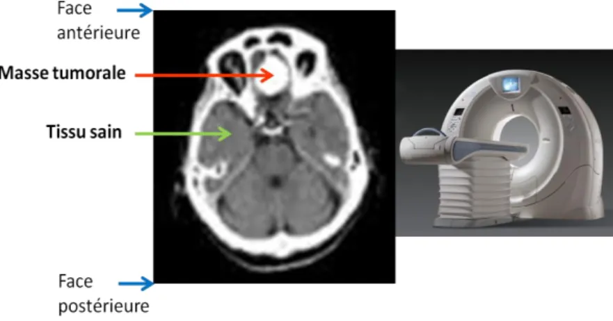 Figure 2 : coupe transversale de cerveau humain porteur d'une tumeur cérébrale visualisée par scanner