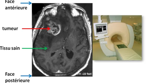 Figure 3 : visualisation par IRM d'un gliome sur une coupe transversale de cerveau humain
