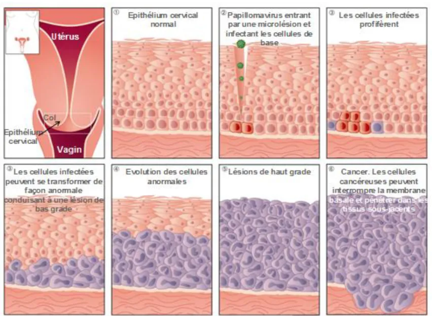 Figure 7. Histoire naturelle du cancer du col de l'utérus. D’après la présentation intitulée Vaccination contre le cancer  du col de l’utérus pour les professionnels de santé de l’Office Fédéral de la Santé Publique Suisse (OFSP)