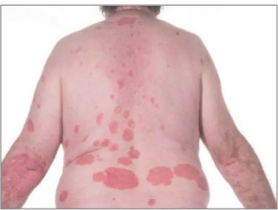 Figure   n°11|   Single   plaque   of   psoriasis,   well    demarcated   and   heavily   scaled