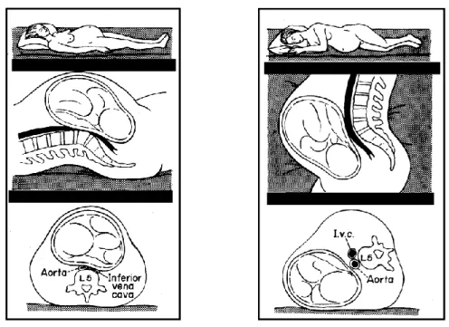 Figure  6  :  Modifications  du  débit  cardiaque  en  fonction  de  la  position  maternelle