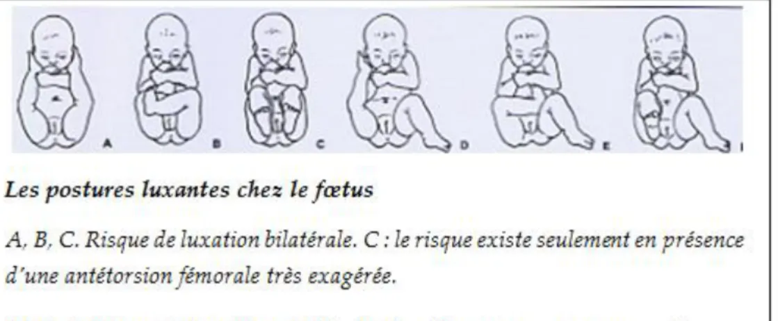 Figure 3 [3]: Les postures luxantes chez le fœtus