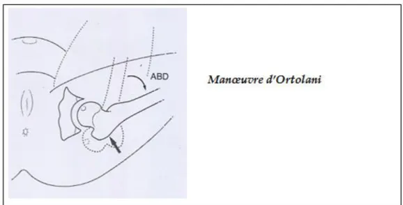Figure 5 [20]: Manoeuvre d'Ortolani
