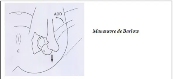 Figure 6 [20]: Manoeuvre de Barlow