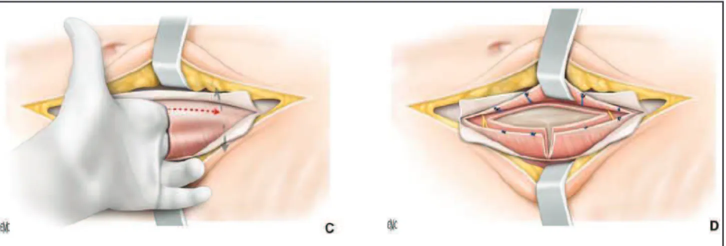 Fig. 21: Dissection mousse rétro-péritonéale (C) et section des muscles en «T» (D) 