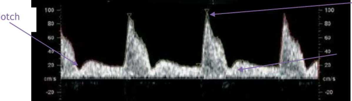 Figure 8: Doppler utérin pathologique [15] 