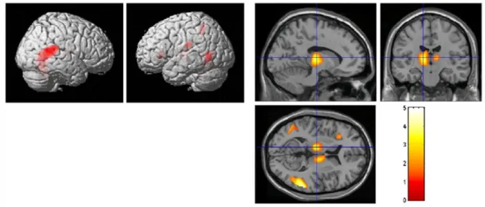 Figure 4 : Aires cérébrales activées lors d’une tâche d’alerte en IRMf (d’après Fan, 2005)  La tâche d’orientation active le cortex pariétal, la jonction pariétotemporale et le Frontal Eye  Field (Fig.5)
