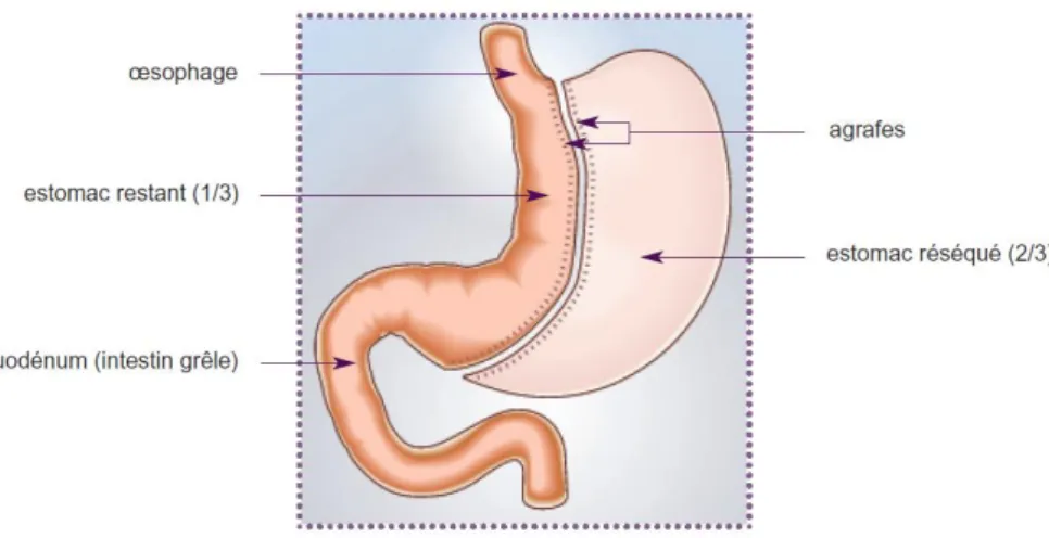 Figure 2 - Gastrectomie longitudinale ou sleeve gastectomy - source HAS 