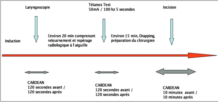 Figure 4. Chronologie de l’enregistrement du CARDEAN au cours des 3 temps opératoires  douloureux 