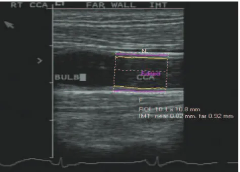 Figure 5. Mesure de l’EIM carotidienne. 