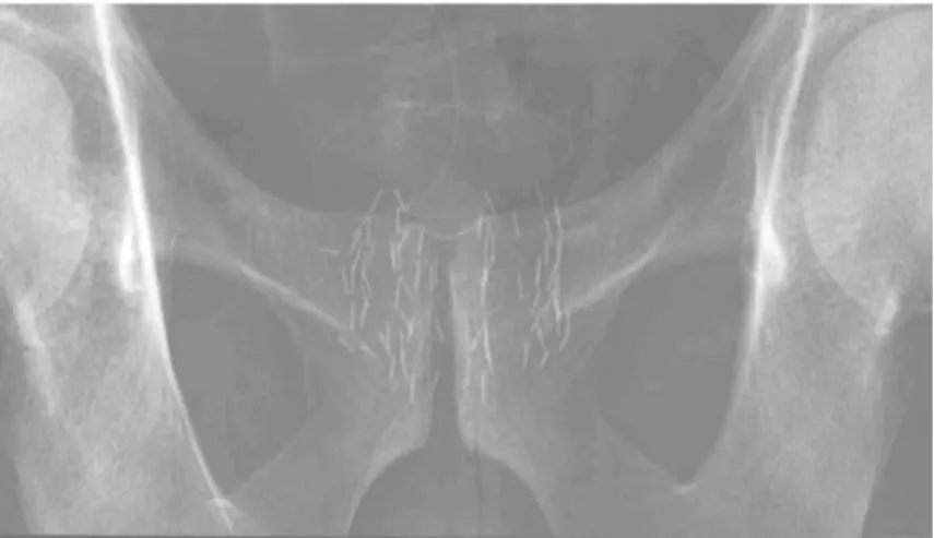 Fig. 9 : contrôle radiographique de l’homogénéité de l’implantation en fin d’intervention 