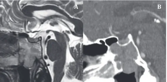 Figure  8 :  adénome  hypophysaire  invasif  en  coupe  sagittale  IRM  T2  (A)  et  TDM  après  injection de produit de contraste iodé (B)